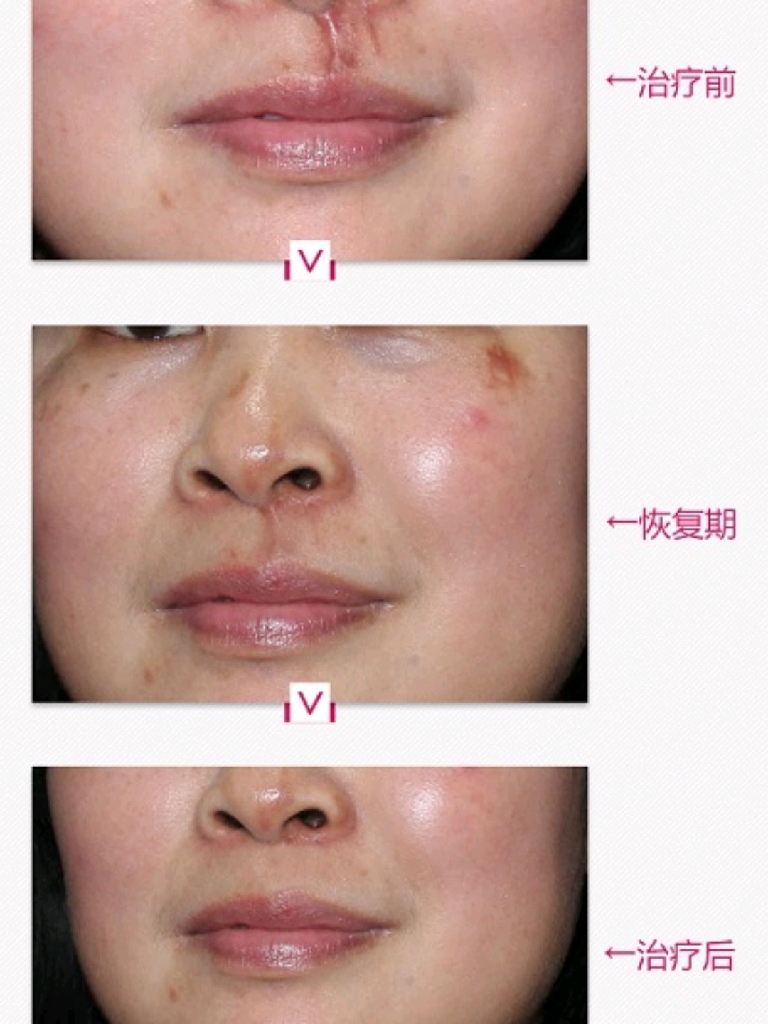 治疗的鼻子外表疤痕修复案例反馈,效果令人满意