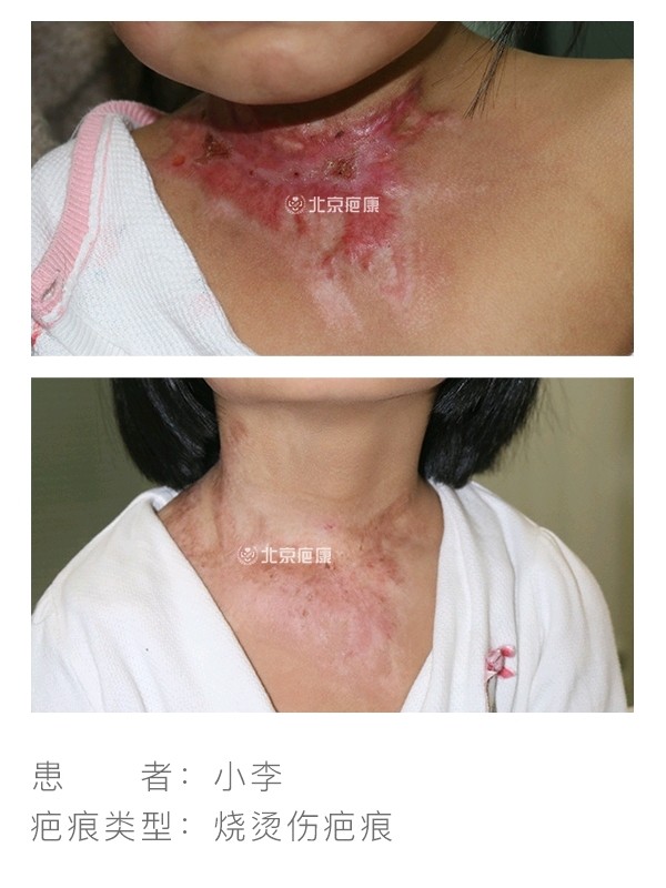 烧烫伤疤痕增生#小李颈部烫伤后,家长发现疤痕随着_圈子-新氧美容