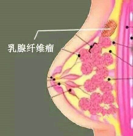 【记笔记】关于乳腺纤维瘤的引发和预防,都在这!