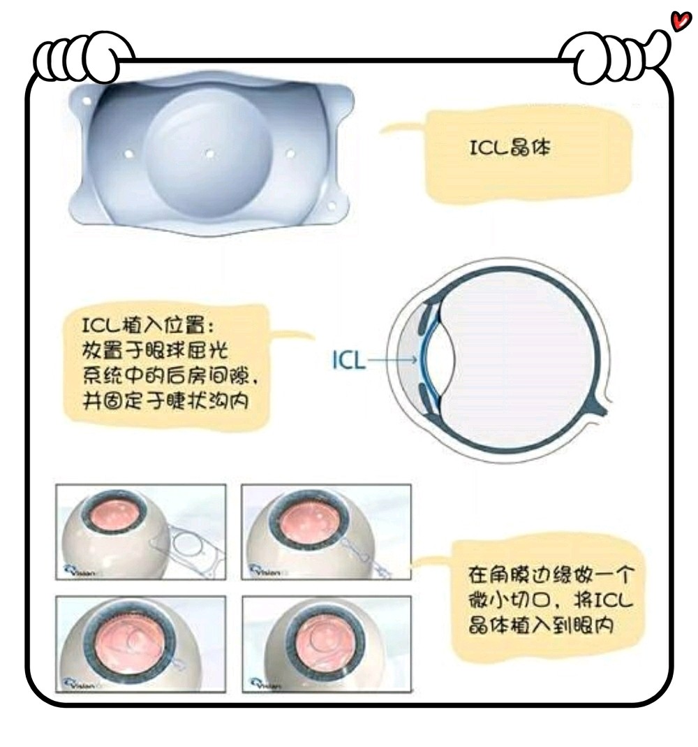 治疗高度近视 为什么医生更推荐icl手术 说起近 圈子 新氧美容整形