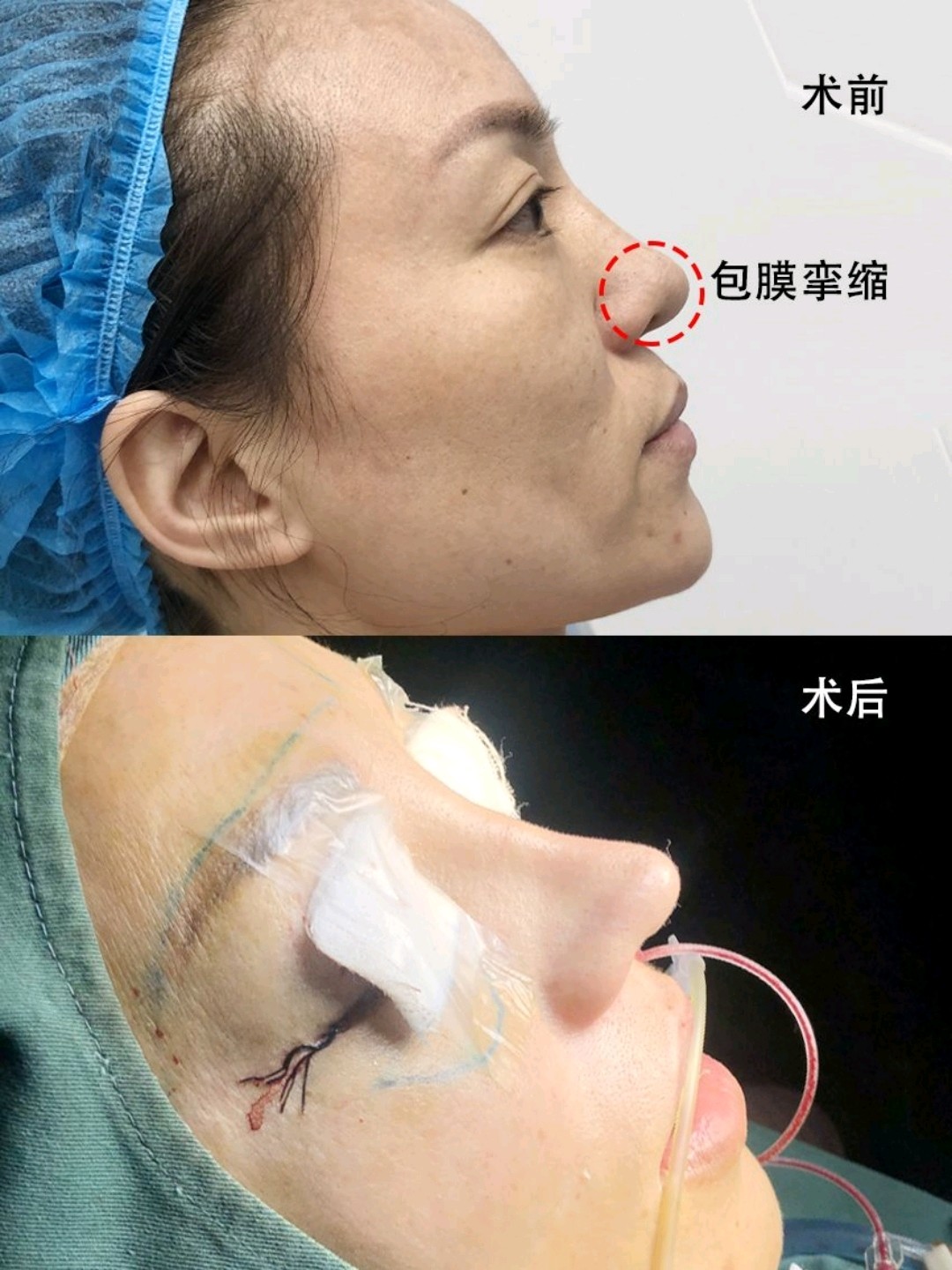 隆鼻失败修复,怎么判断自己鼻子失败了?