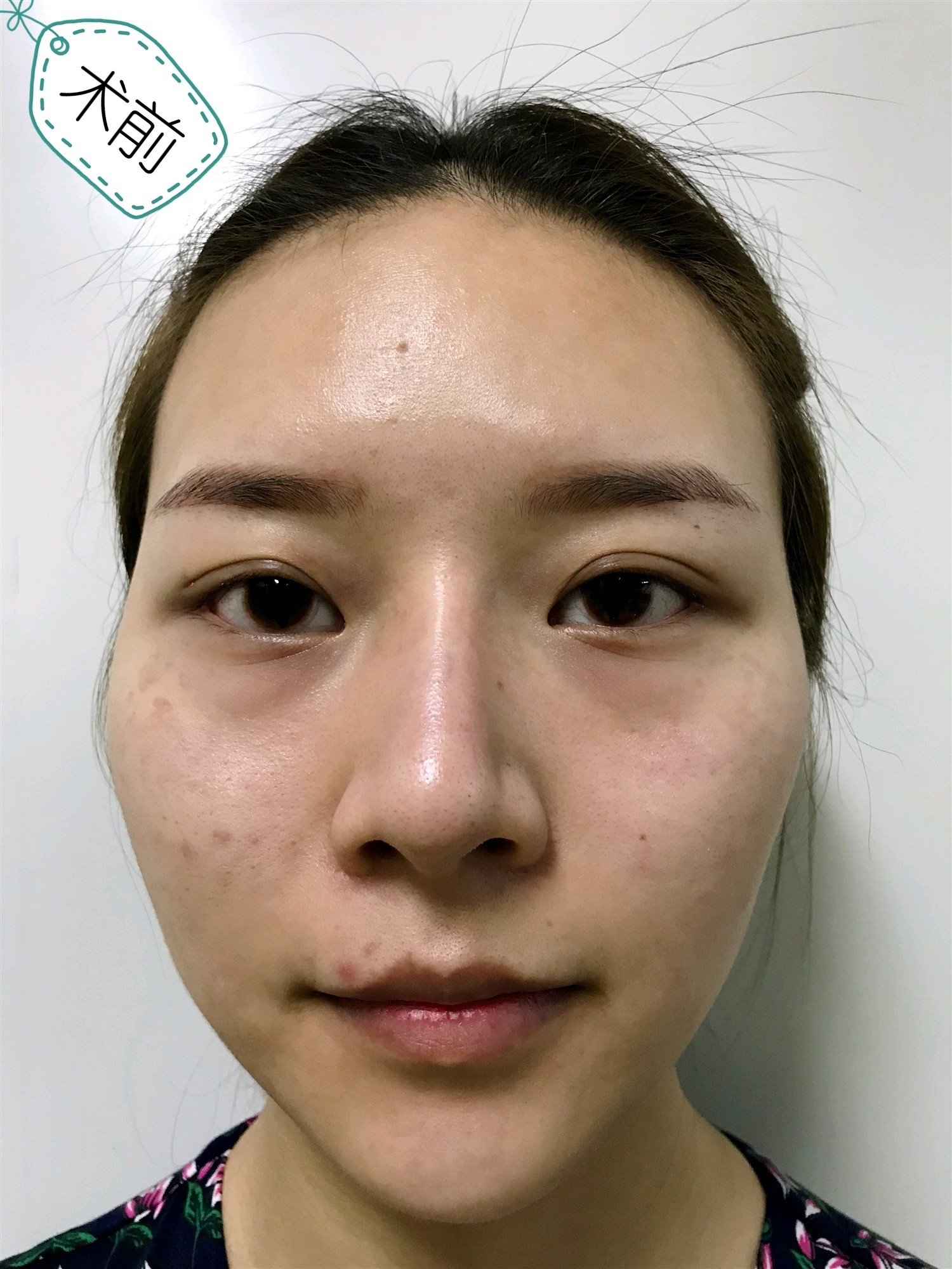 填充面部脂肪保持多久_填充面部脂肪保持几年_脂肪面部填充保持多久