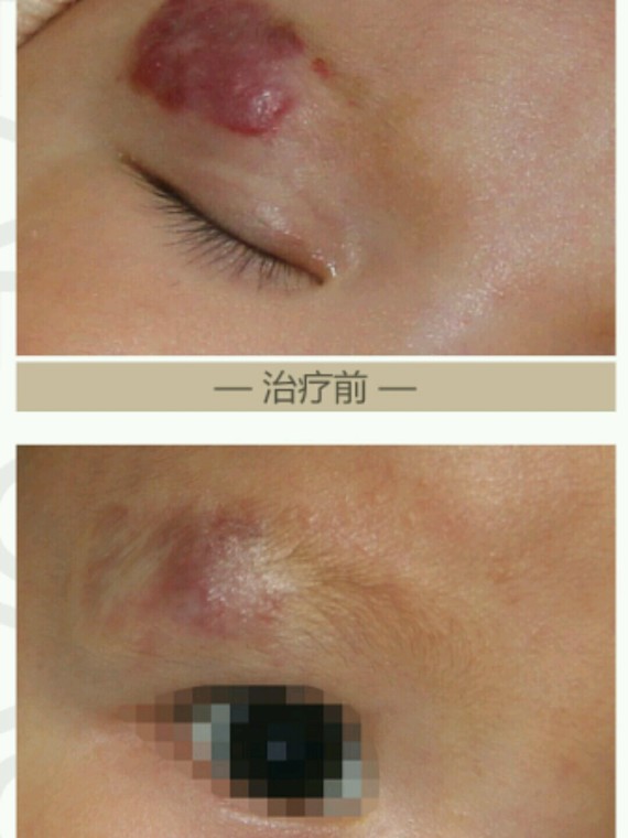 宝宝专题30宝宝血管瘤最佳治疗时间是什么时候