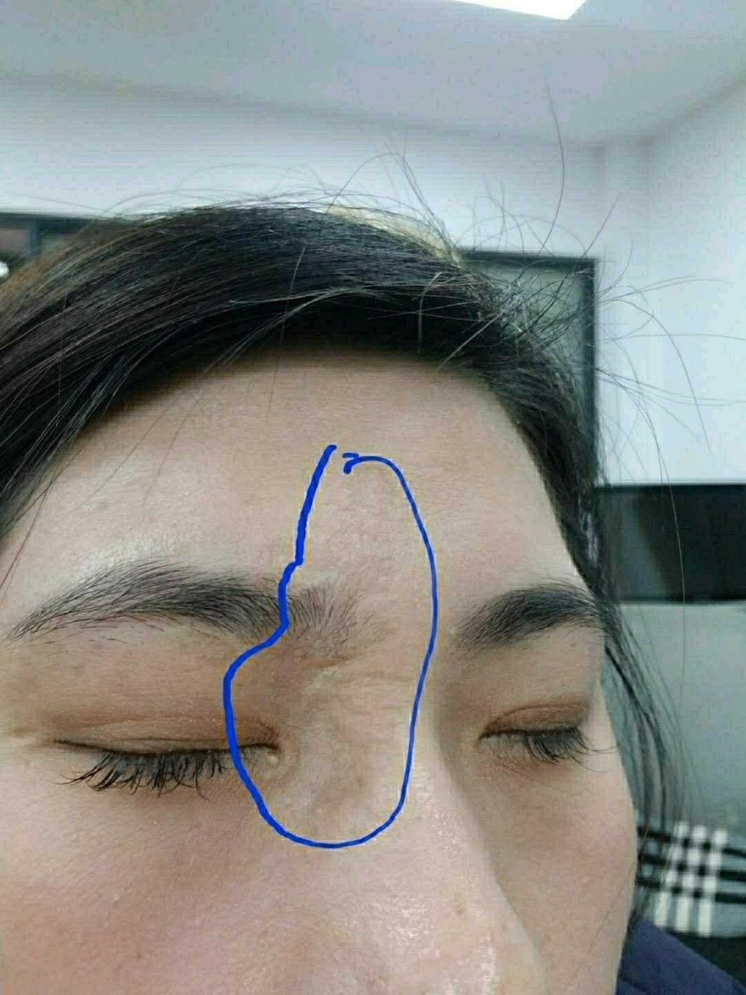 激光去疤修复小时候,出水痘,太痒,导致出的抓痕.😂_圈子-新氧美容整