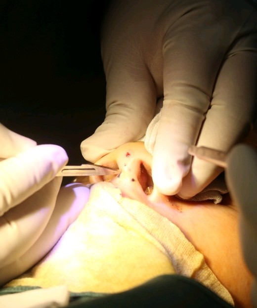 04肋软骨隆鼻全过程现在很多90后姑娘明明很瘦,可是一拍起照来总