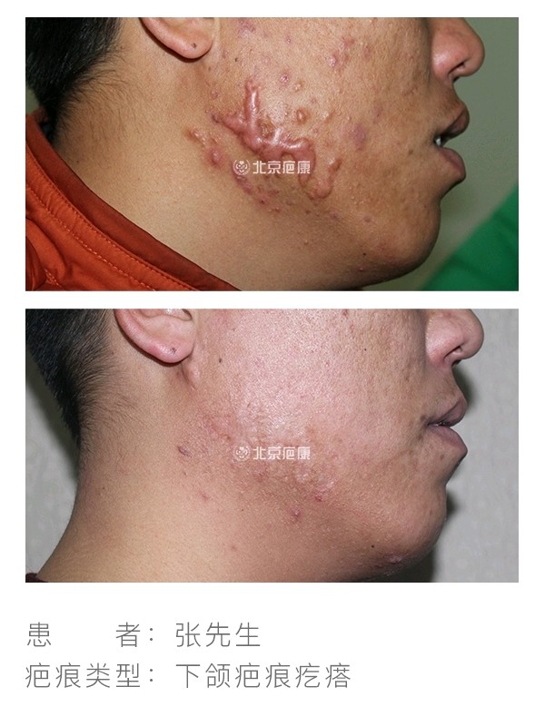 腮腺混合瘤手术后疤痕图片