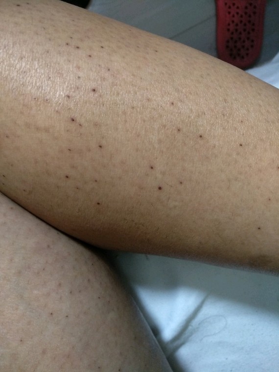 电针绝毛,麻烦,需要一个毛孔一个毛孔脱.但是有1/_圈子-新氧美容整形