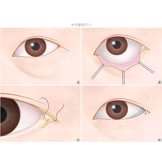 作为整形医生,都会碰到各种各样的眼睛,单眼皮的,上睑下垂的,内眦赘