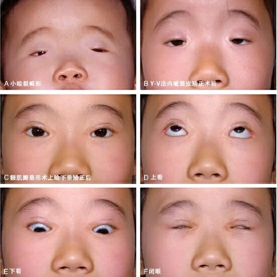 眼睛太小,是一种病!