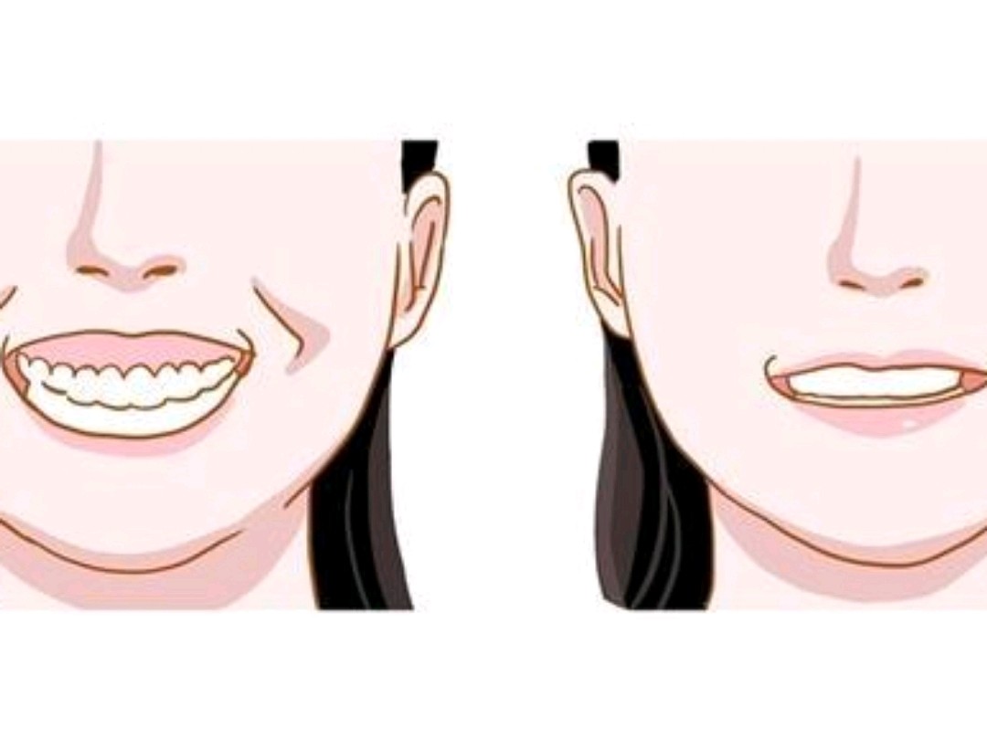 78让毁容不倦的"露龈笑"能"放肆笑",你需要掌握这_圈子-新氧美容