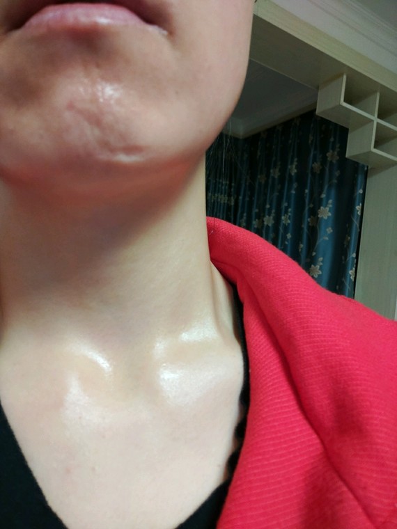 下巴摔伤留下的凹陷疤痕,约22年的旧伤疤.请问该怎么治疗呢?