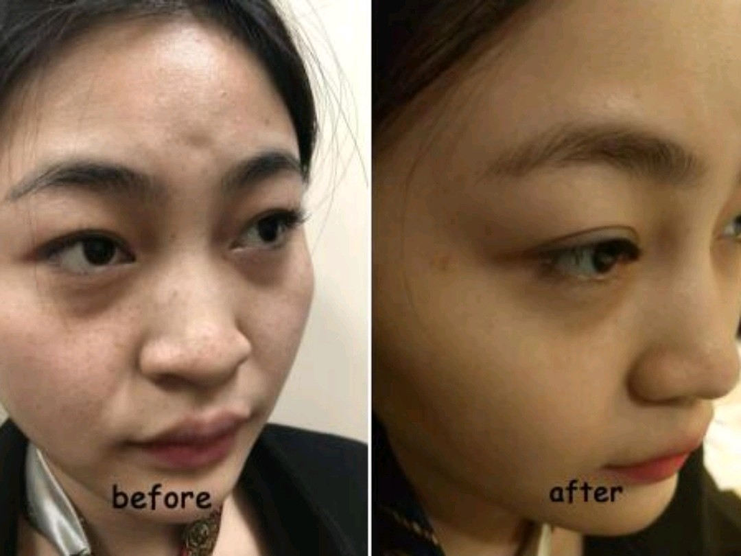 面部斑点暗黄毛孔粗大肤色不均匀妹子的福音来啦