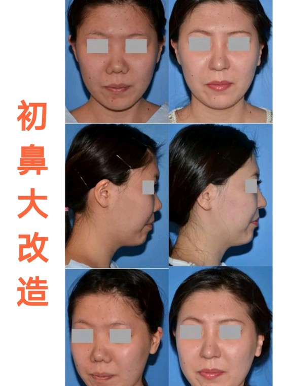 鼻翼基底提升术可以帮你变"最佳侧颜"哦…(_圈子-新氧美容整形