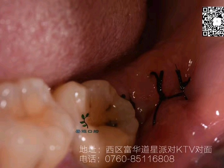 "之前的智齿长歪了把前面的7号牙给顶烂了,超痛,2_圈子-新氧美容整形