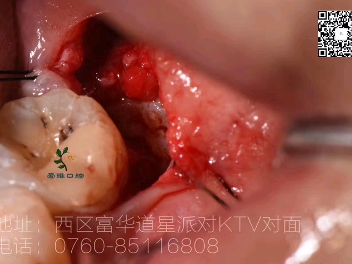 "之前的智齿长歪了把前面的7号牙给顶烂了,超痛,2_圈子-新氧美容整形