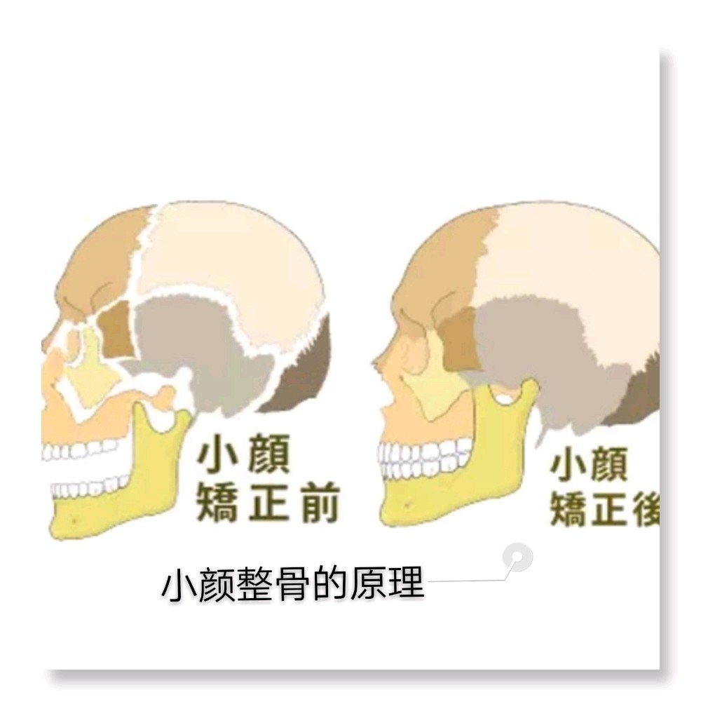 让人脱胎换骨的 日式整骨 上 虽然如今不管是中 圈子 新氧美容整形