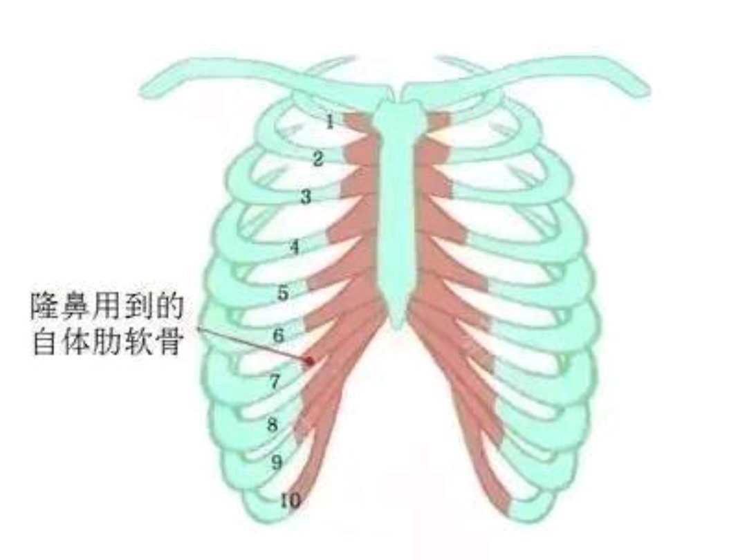 肋软骨钙化是什么,还能做隆鼻吗?