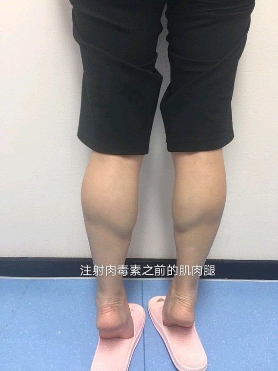 我天生小腿粗壮而且肌肉外翻鼓起一坨一坨的伦家可系小仙女啊~~~运动