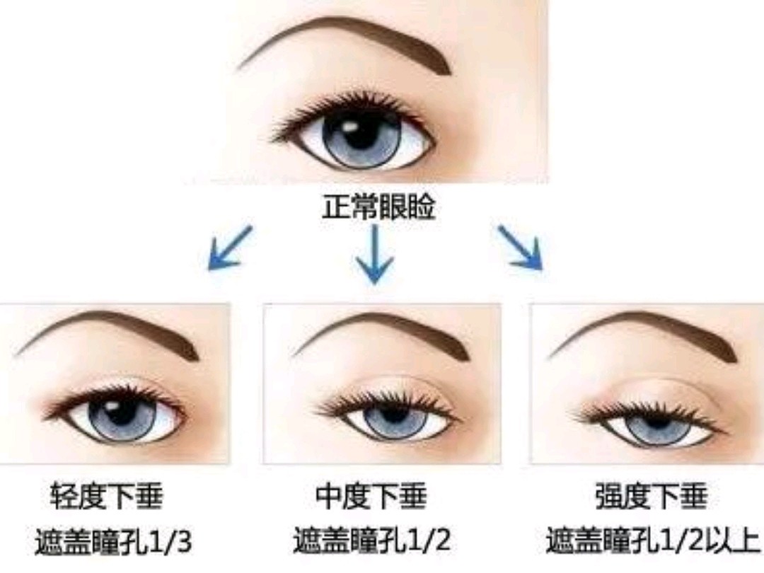 做双眼皮先测一测有没有"上睑肌无力"吧