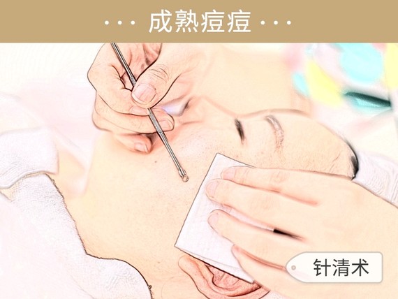 沈梦辰带杜海涛挤痘痘,疼哭杜海涛,祛痘真有这