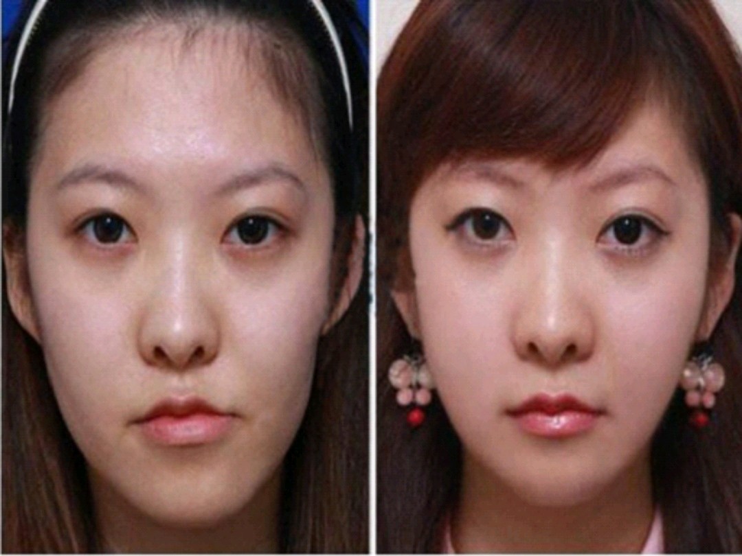 左右两边脸一大一小不一样,打瘦脸针有用吗?