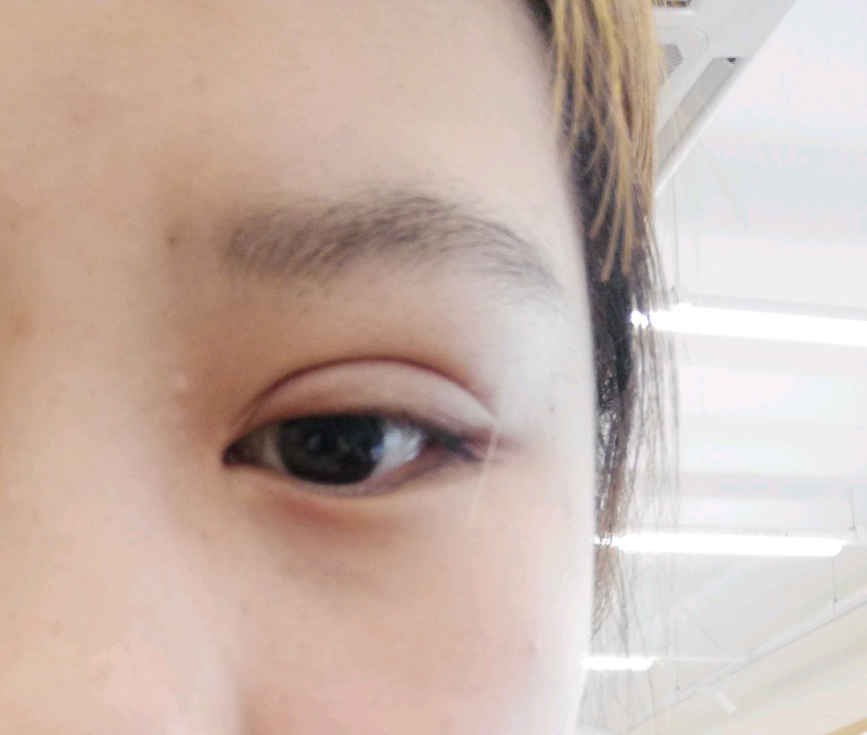 去年七月五号做的双眼皮,右眼角一直有褶皱而且一直很肿,也不知道什么