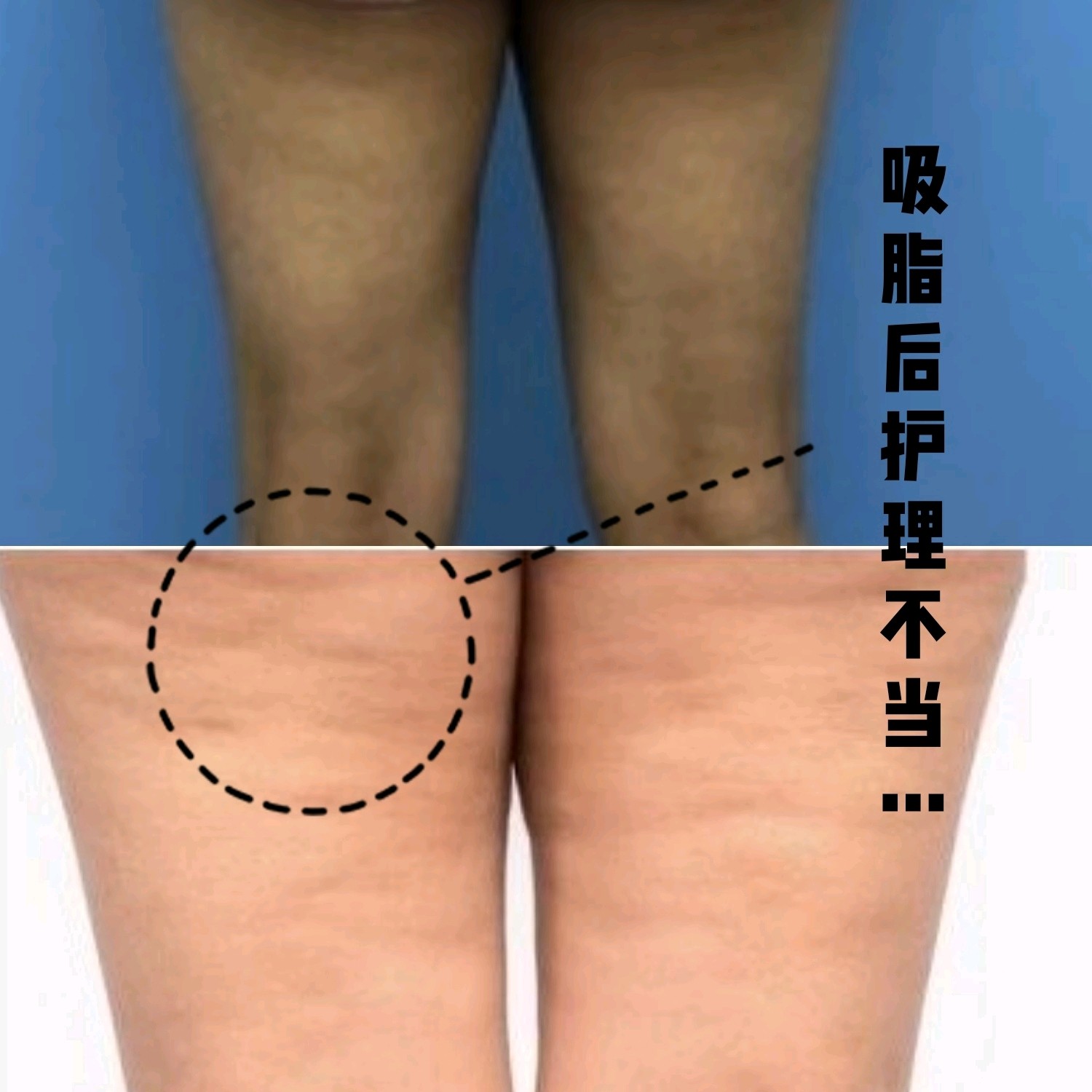 吸脂过后护理不当导致皮肤"肿块"——你怕不怕?