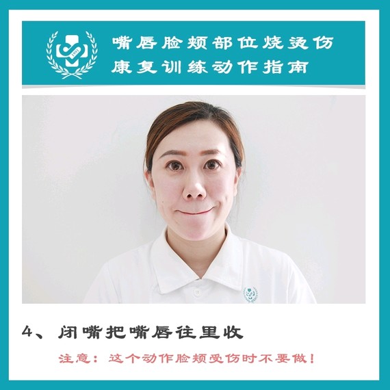 脸颊部位烧烫伤康复训练动作指南:北京疤康护