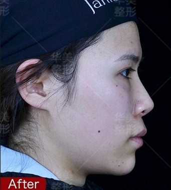 🙋玻尿酸垫过的下巴,还能用假体垫下巴吗?😜广大爱美_圈子-新氧美