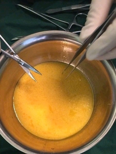 自体脂肪填充额头