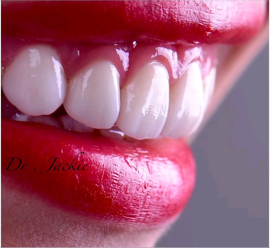 照片里的是一位氟斑牙姑娘,可想而知笑起来多么不自信,做完牙齿贴面