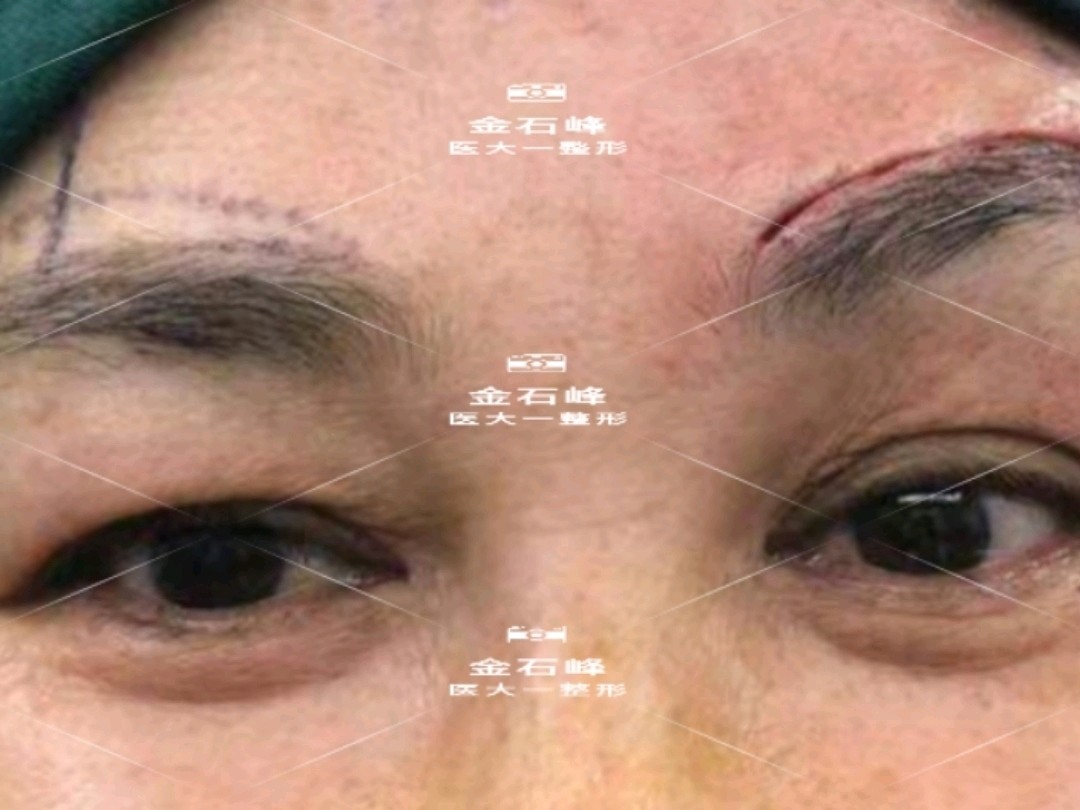 再发一个一侧眉上切悬眉术后即刻,之所以选择眉上切是_圈子-新氧美容