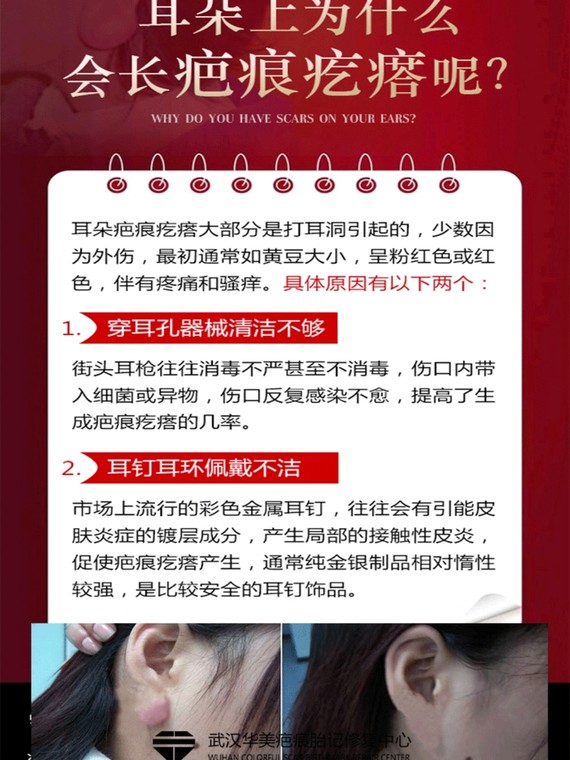 耳朵疤痕疙瘩,治愈秘籍全在这里在看到很多来