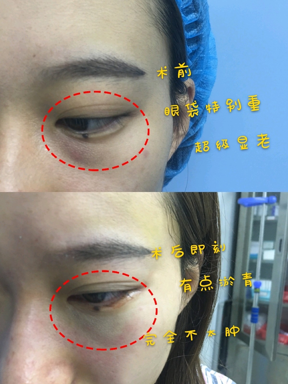 真人体验,分享心得,不肿的内吸祛眼袋