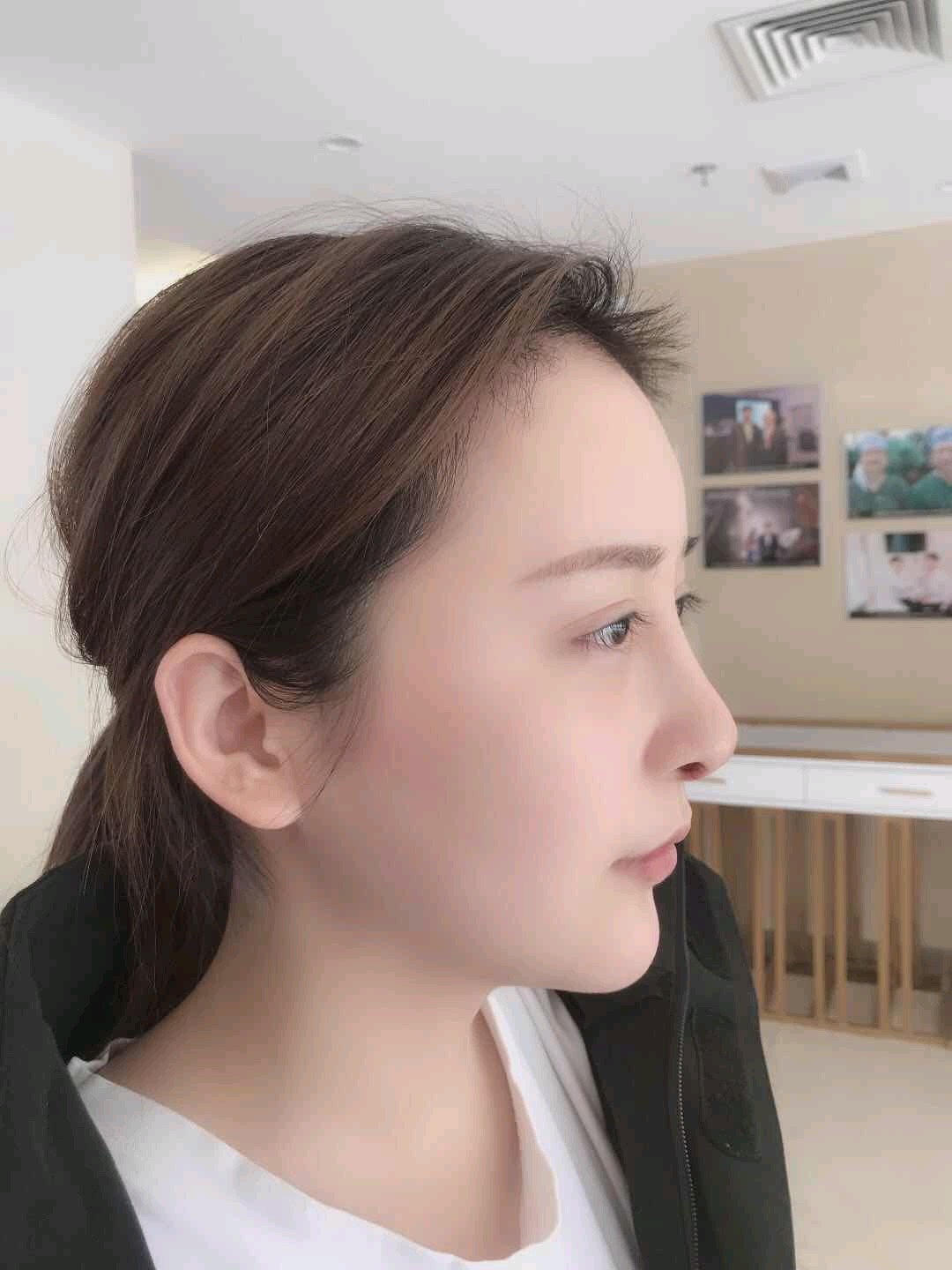 我的肋软骨鼻修复手术已经两个月啦!跟大家分享一下隆鼻经历.