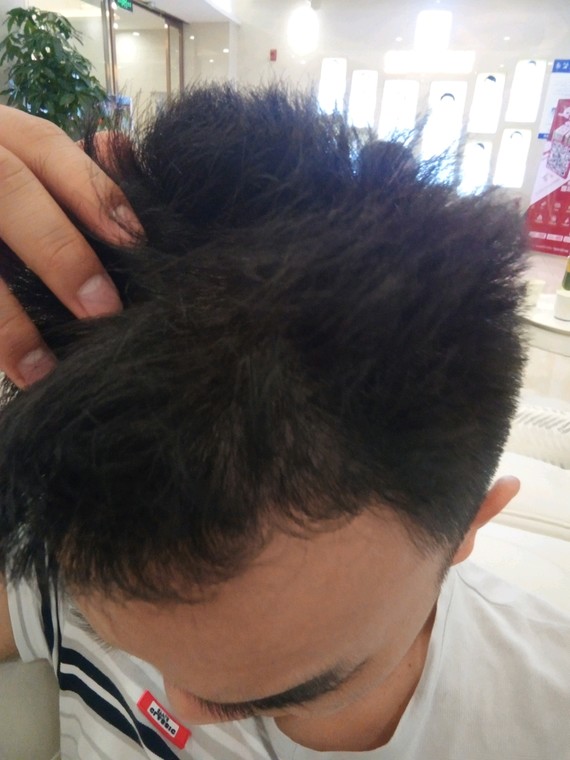 南宁植发哪里好,我选择南宁kFY植发医院多了,