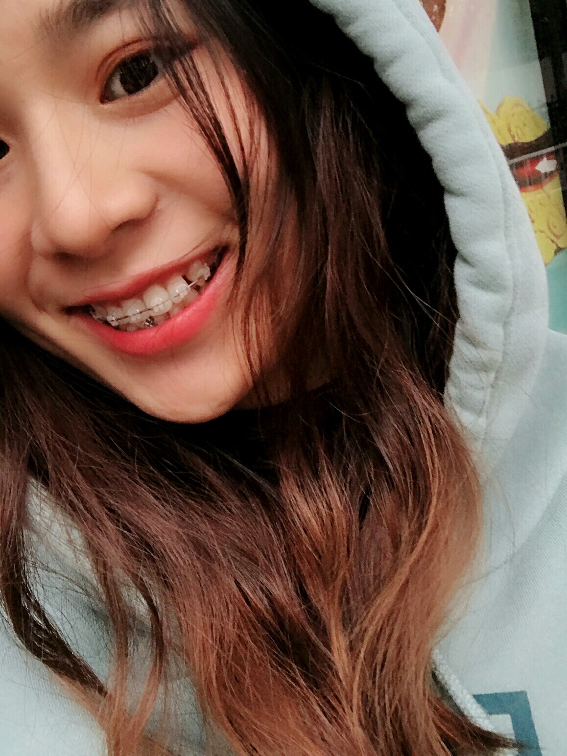 全网通缉最美笑容谁说牙套妹不能笑