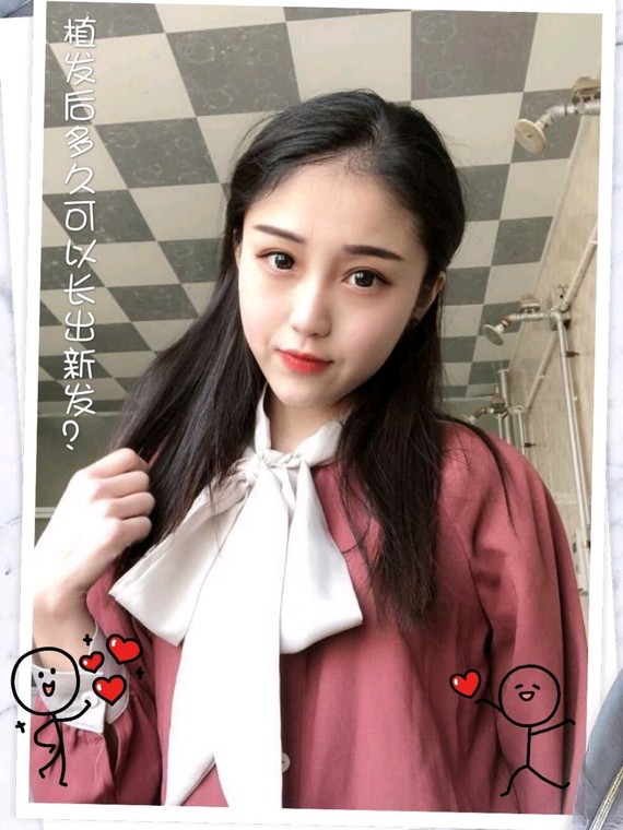 植发后多久可以长出新发?头发种植后可以看到