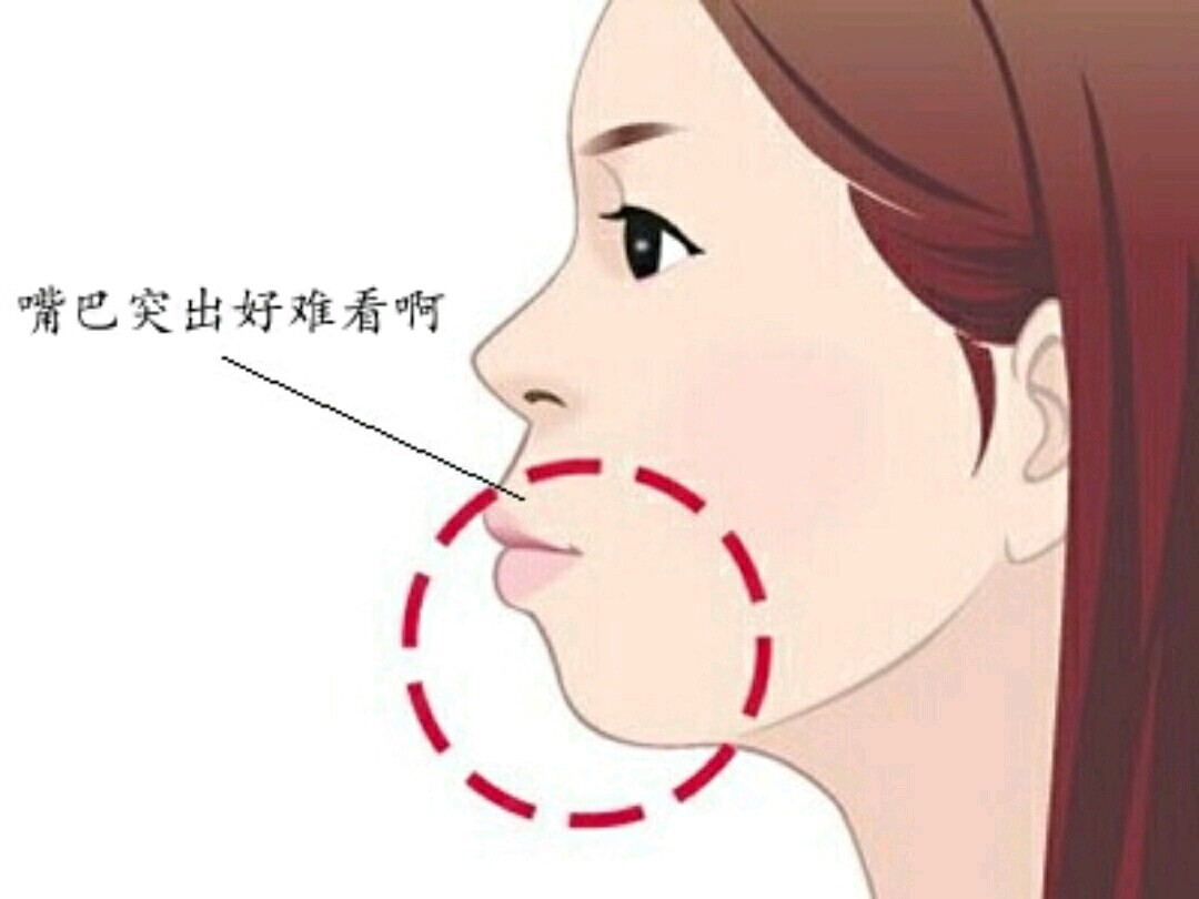 这类人通常是没下巴 鼻子低 嘴巴凸,尤其从侧面看更为明显