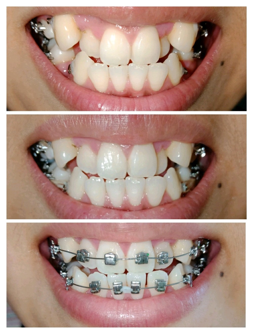 不动刀的佛系变美,牙齿矫正必须有位置!