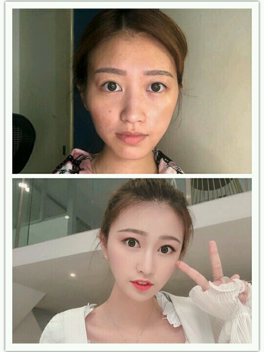 自体脂肪面部填充后成了硅胶脸?这组案例会告诉你答案