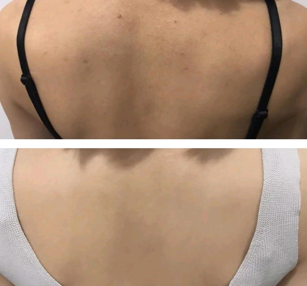 那这个时候背后痘痘困难户难道就不配过美美得度过这个夏天了吗!