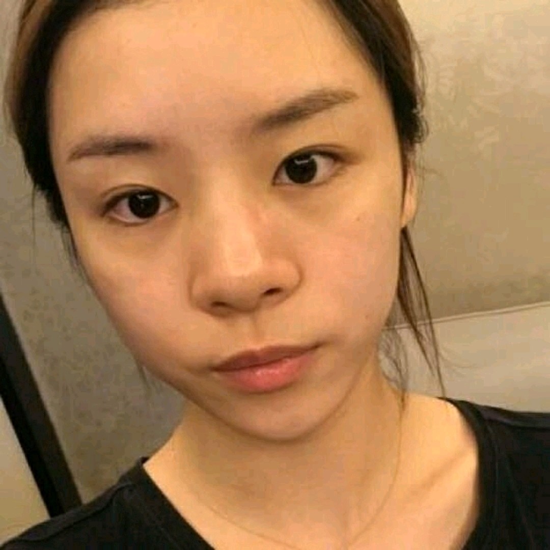 97我的鼻子是属于蒜头鼻那种,又塌又扁又大,我其他的_圈子-新氧美容