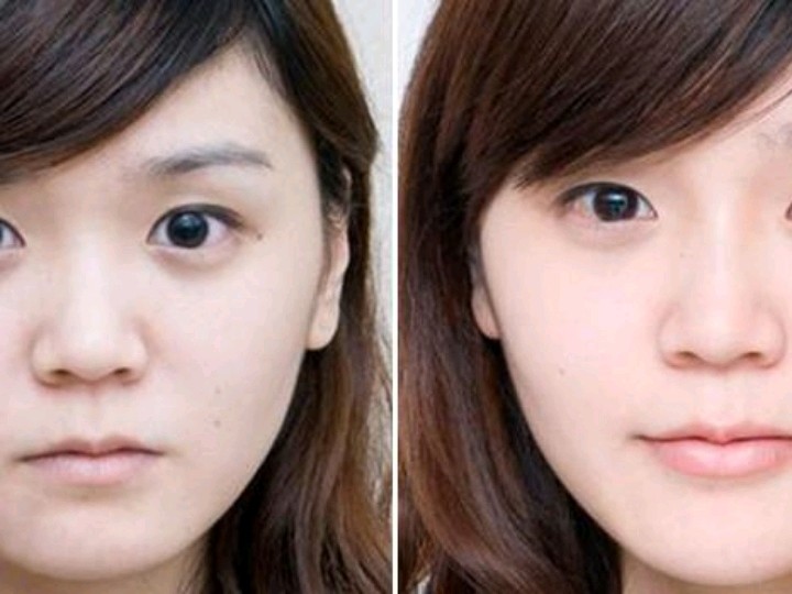 嘴角上扬术又称之为唇形调整手术,是能达到双唇尾部自_圈子-新氧美容