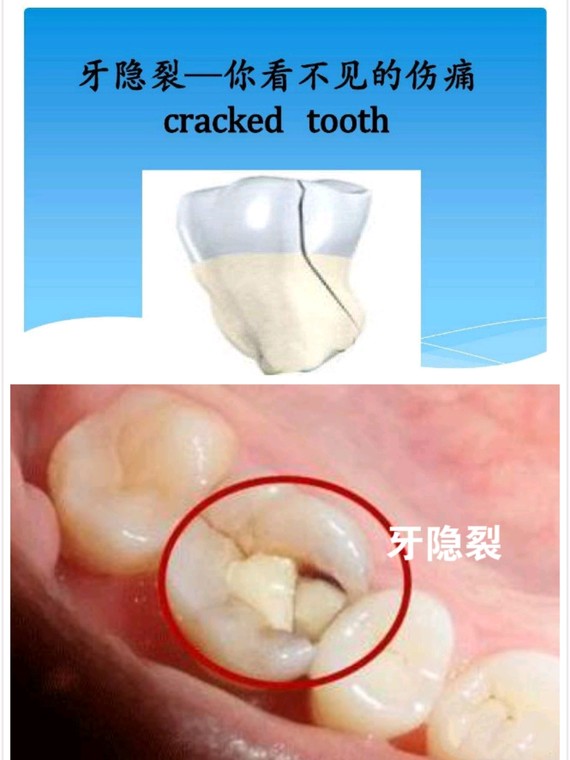 我们先来了解一下什么是隐裂牙? 牙隐裂指牙齿