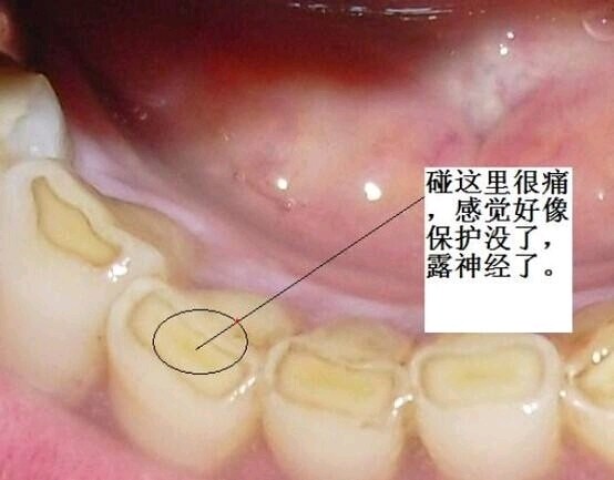牙隐裂症状图片