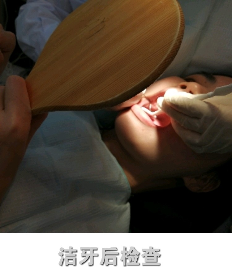 洁牙期间,嘴巴里放了一根吸唾管,用来吸水跟口腔还有掉下来的污垢的.