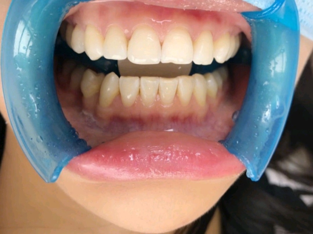 分享一下我做牙齿贴片的心得!