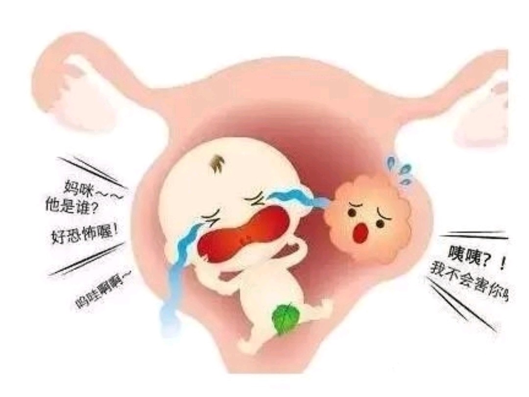 子宫肌瘤会把胎宝宝"挤掉"吗?