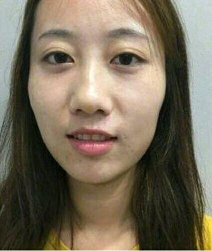 隆鼻后鼻子发红是怎么回事隆鼻术后可能会出现